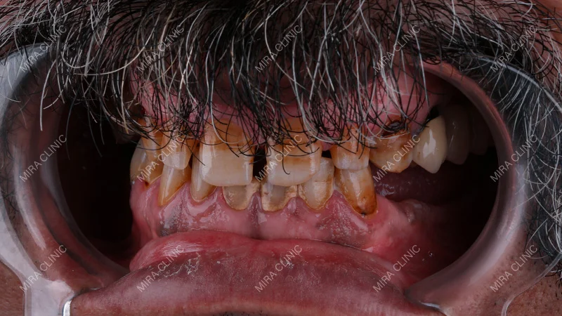 Missing Back Teeth